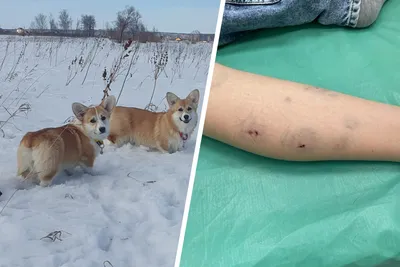 С мая по июль в Мангистаускую детскую больницу госпитализировано 290 детей  с укусами