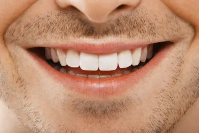 Голливудская улыбка в Одинцово от стоматологии «АРТ»
