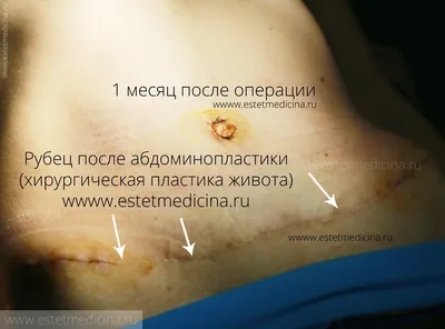 Умбиликопластика | Пластический хирург Маркушин