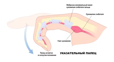 Кератоз Кожи - Симптомы кератоза Profderm