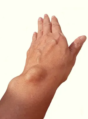 Шишки на руках под кожей: причины, симптомы и способы лечения