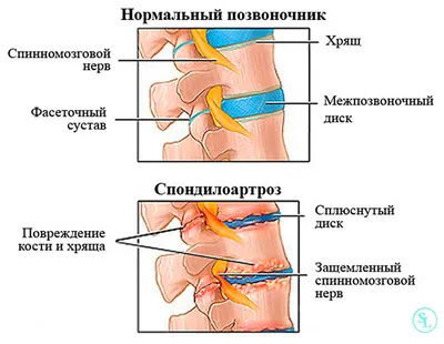 Комплекс базовых упражнений при межпозвонковой грыже