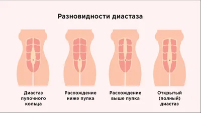Упражнения для женщин в домашних условиях - Казанский центр кинезитерапии.  Лечение грыжи без операции