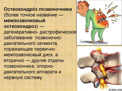 Как спать при шейном остеохондрозе