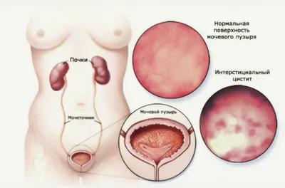 Урологические заболевания у мужчин фото фотографии
