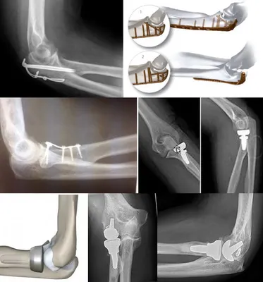 Травматические повреждения и заболевания локтевого сустава