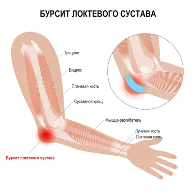 Бурсит локтевого сустава - Быть здоровым - это элементарно - УЗ \"16-я  городская поликлиника\"