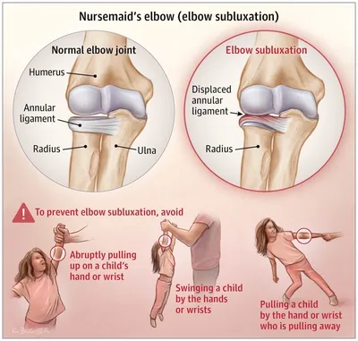 Подвывих локтевого сустава\" у детей (локоть няньки) | Пикабу
