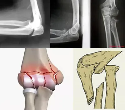 Травматические повреждения и заболевания локтевого сустава