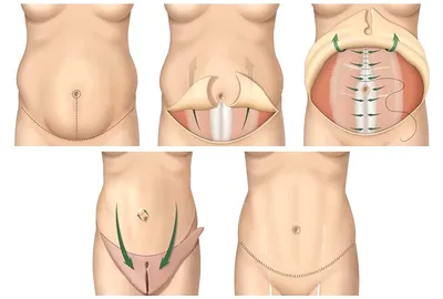 Пластика живота или абдоминопластика
