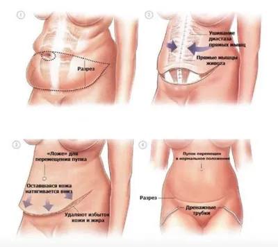 Абдоминопластика фото до и после — Центр пластической хирургии Daily Medical