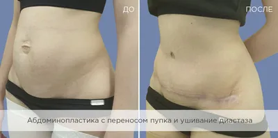 Лечение диастаза прямых мышц живота в Киеве | МЦ Лелека