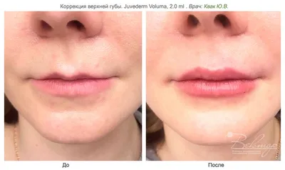 Коррекция и увеличение губ филлерами и гиалуроновой кислотой в клинике  «Вектор» в Москве