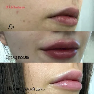 Отек после увеличения губ: причины появления и рекомендации