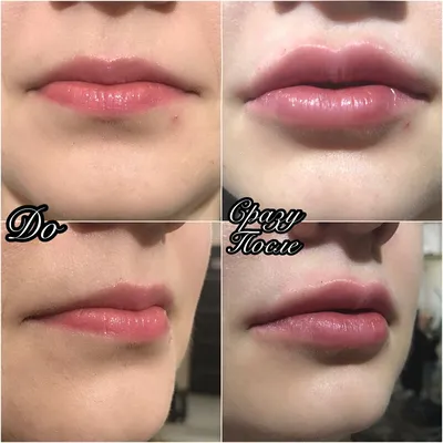 Увеличение и бьютификация губ. До и После (Фото)