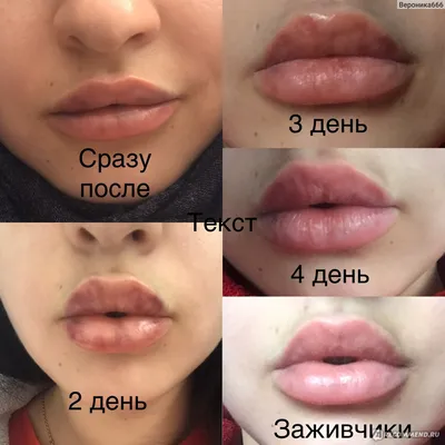 Тамара Оврутская - Какие могут быть осложнения? Для салонов красоты увеличение  губ филлерами является стандартной безвредной процедурой. Тем не менее, она  действительно безвредна только при правильном уходе. Халатное отношение к  процедуре может