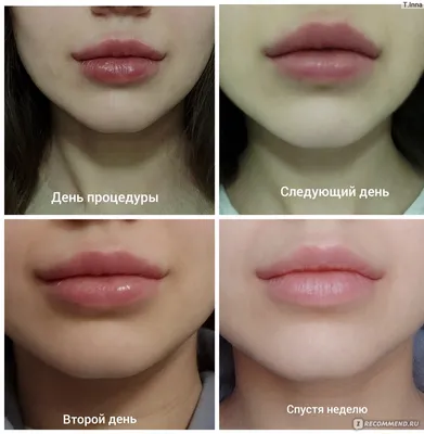 Увеличение губ гиалуроновой кислотой в Кишиневе и Харькове - фото до и после  |Honest Beauty