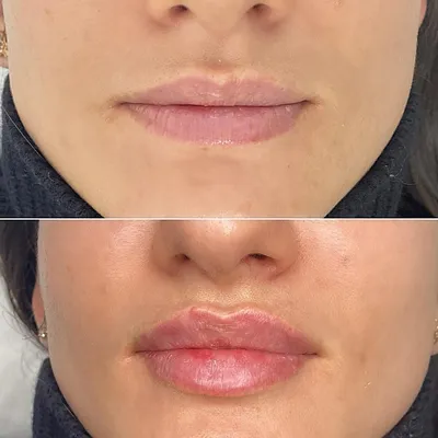 Как выглядят ЗАЖИВШИЕ губы после 1 мл филлера , спустя 3 недели . Dr.  Matveeva #увеличениегуб #красивыегубы #косметолог… | Instagram