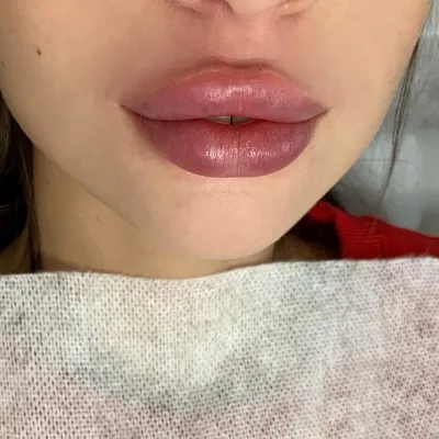 YB Cosmetology - Увеличение губ. Сразу после процедуры. Отек 40%,  предупреждаю всех. Зажившие губы скоро будут в ленте👄👄👄 | Facebook