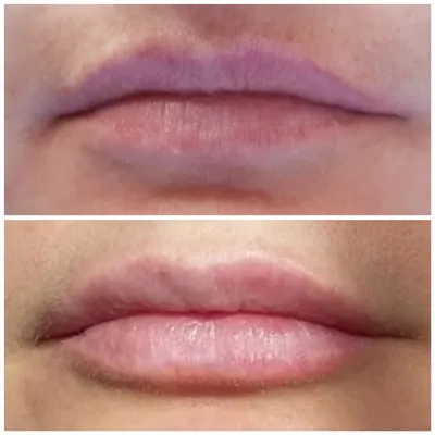 Увеличение губ в Киеве - только врачи-косметологи - Лицензия МОЗ - NATEO  Beauty Studio