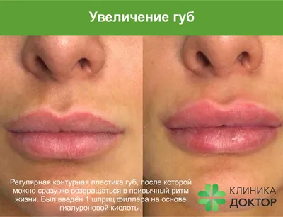 Увеличение губ в Чехове от сети клиник «CMD»