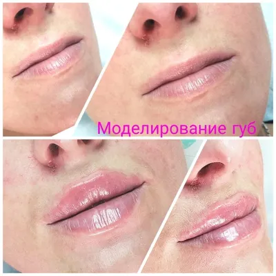 Увеличение губ гиалуроновой кислотой в СПб в клинике \"Доктор\"