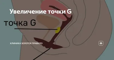 Увеличение точки G | Клиника Золотое Правило | Дзен