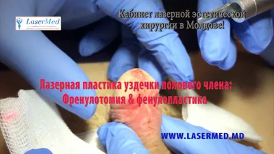 Пластика (френулопластика) уздечки полового члена: как проходит, цена в  Москве в клинике АльтраВита