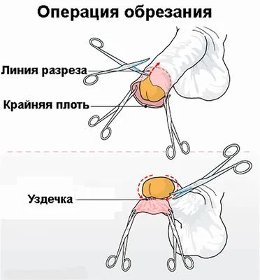Ответы Mail.ru: уздечка у мужчины. должна ли рваться уздечка при половом  акте или ее надо обрезать