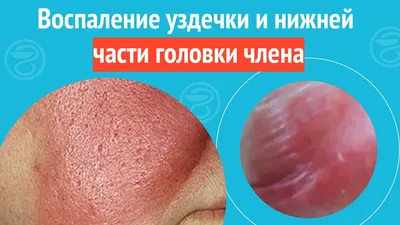 Операция по обрезанию крайней плоти (циркумцизия) у мужчин в клинике Уфы:  цена и отзывы