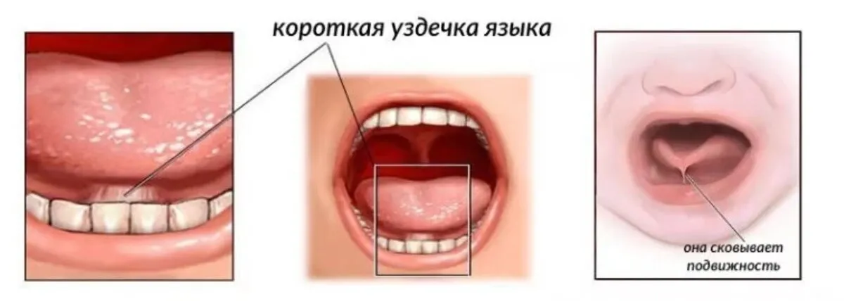 Фото Языка У Новорожденных На 2 Месяца