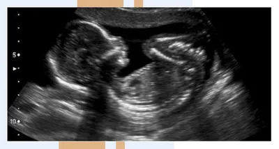 УЗИ для определения беременности на ранних сроках | Центр медицины плода