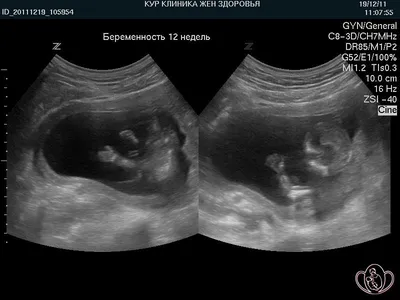 Что беременным нужно знать об ультрасонографии?