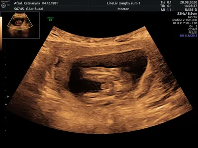 УЗИ трансвагинальным датчиком - «УЗИ при беременности. Возможно ли  определить пол ребенка уже на первом УЗИ в 11-14 недель? » | отзывы