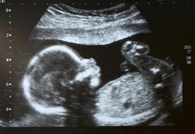 12 недель беременности: что происходит, ощущения в животе, размер плода, пол  ребенка на УЗИ | Двенадцатая неделя беременности