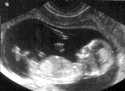 Пренатальный УЗИ-скрининг 1 триместра при беременности (12 недель) -  Клиника Академия-ВИП
