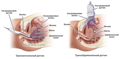 УЗИ органов малого таза: как делается, что показывает и как подготовиться к  процедуре