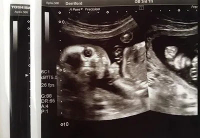 Снимок УЗИ вызвал шок у беременной девушки, ведь ещё не рождённый ребёнок  смотрел прямо на неё