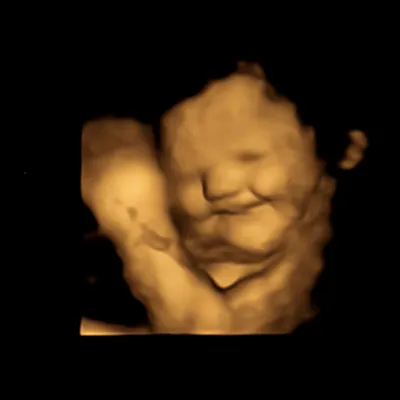 3 месяц 10 недель. Первое Узи. Первая фотография нового ребенка из монитора  врача.
