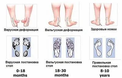 Вальгус у детей в 3, 4 года | Мама зануда