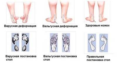 Как определить плоскостопие у ребенка? Лечение разных видов деформации стопы  у детей в НМИЦ им. Г. И. Турнера
