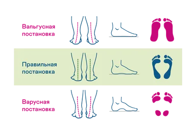 Студия Osteo.Family - Вальгусная деформация стоп. Что это такое? ⠀ Вальгус  проявляется заваливанием стопы в области голеностопного сустава к  внутренней ее поверхности. При этом пятки выворачиваются наружу. Ноги у  ребенка становятся буквой