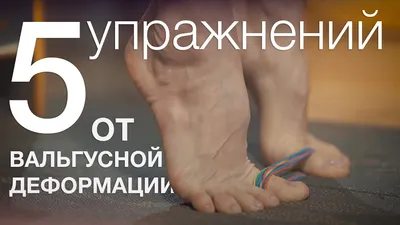 Вальгусная деформация стопы (вальгус) у детей — причины, симптомы, лечение