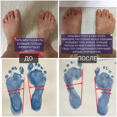 Как могут помочь тейпы при вальгусной деформации стопы у ребёнка