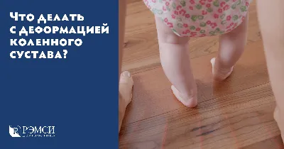 Вальгусная деформация стопы | Лечение вальгуса стопы у детей и взрослых ᐉ  Ladisten