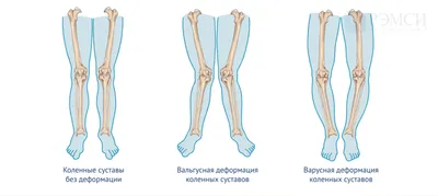 Деформация коленного сустава | Блог о здоровье