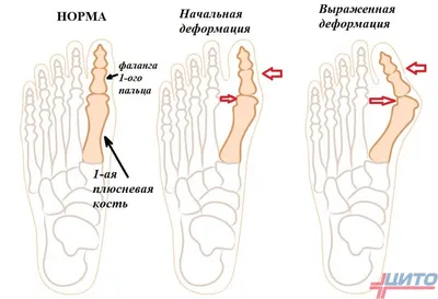 Причины деформации коленных суставов - статьи клиники Доктора Глазкова в  Москве