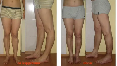 Вальгусная деформация коленных суставов у детей и взрослых. | ВКонтакте