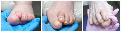 Ортопедическая обувь при вальгусной деформации стопы - статья Мир Орто