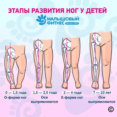 Вальгусная деформация стопы у ребенка фото фотографии